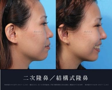 隆鼻重修二次隆鼻案例20041-右90