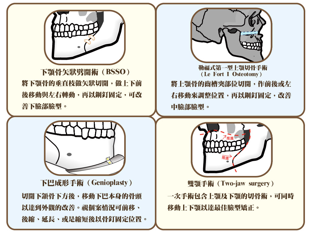 正顎手術種類說明文字圖示插圖