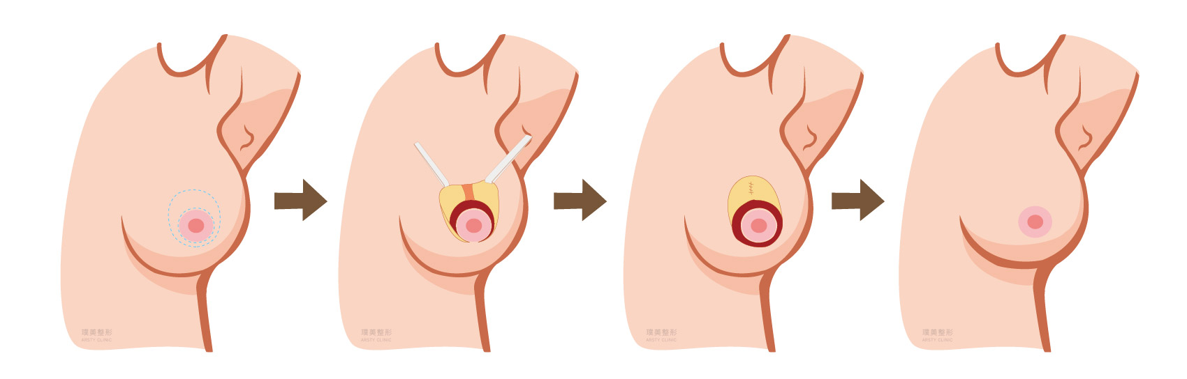 縮胸手術原理 圓形切口提乳法
