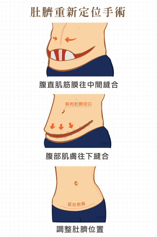 肚臍定位 腹直肌 腹部拉皮手術 產後拉皮 1